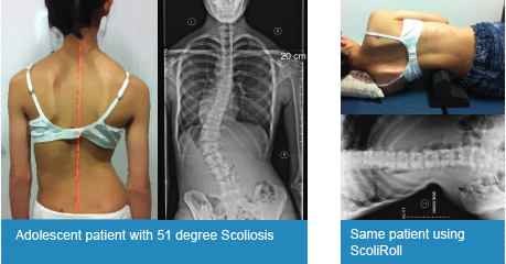 Results for ScoliRoll® Lumbar